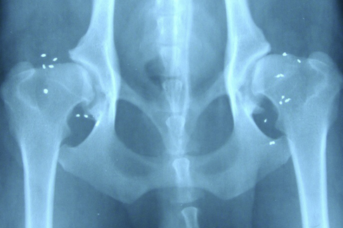 Röntgenbild einer Goldbehandlung gegen Arthrose