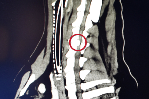Röntgenbild eines Bandscheibenvorfalls